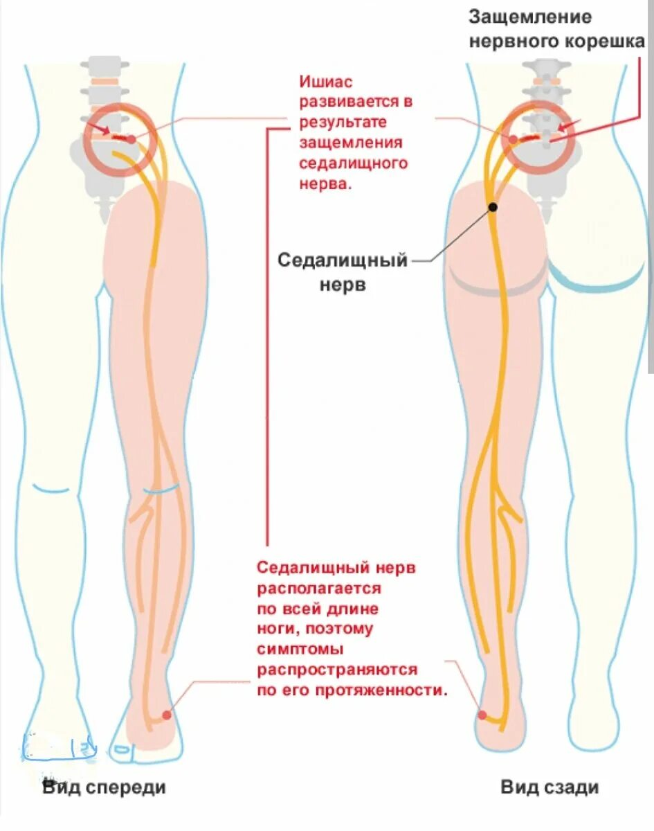 Защемило нерв в ноге чем лечить