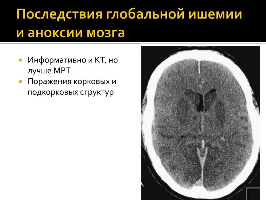 Поражение мозга последствия. Ишемическая аноксия. Аноксическое поражение мозга. Стадии ишемии головного мозга на кт.