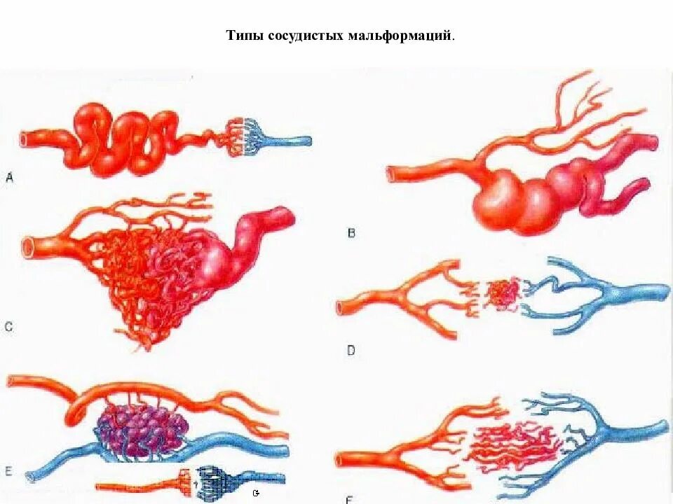 Сосудистая аномалия. Артериовенозная мальформация сосудов. Артериовенозные мальформации сосудов головного мозга. Артериовенозная дисплазия классификация. Классификация артериовенозной мальформации.