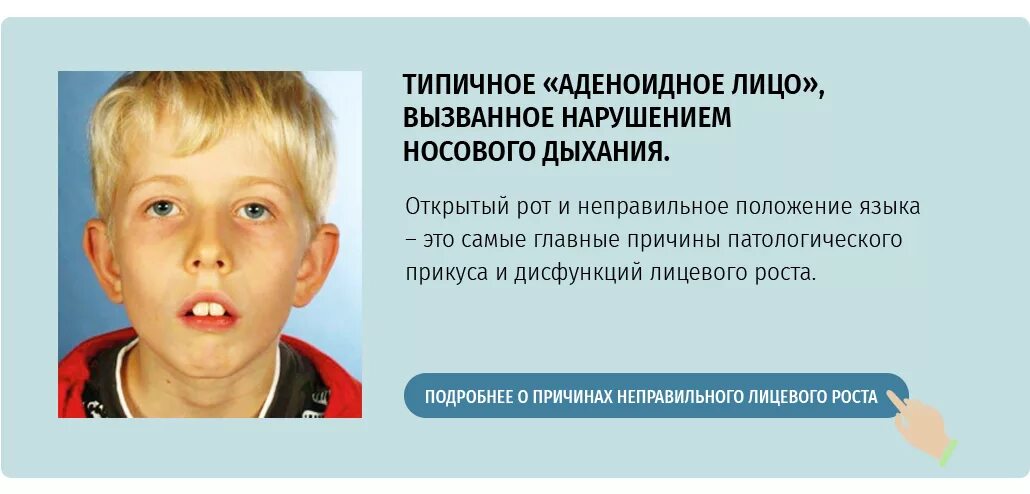 Дышит какое лицо. Аденоидный Тип лица у детей. Аденоидитное лицо у ребенка.