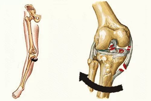 Признаки порванных связок. Растяжения, повреждения связок. Признаки растяжения сухожилия. Разрыв повреждение связок признаки. Признаки растяжения сухожилия.
