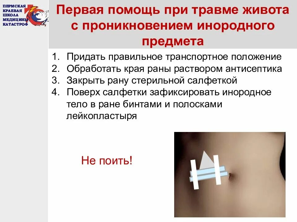 Помощь при травмах живота. Первая помощь при травме живота. первая помощь при ранении живота. оказание первой помощи при повреждении живота. первая помошт при ранение дивота.