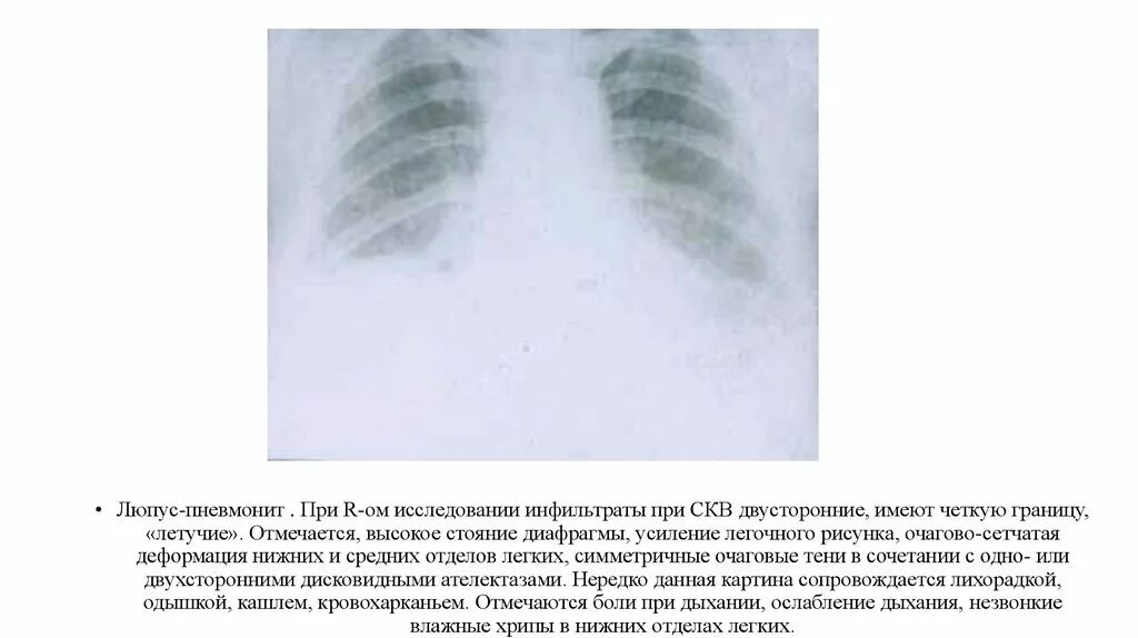 Поражение сердца при системной красной волчанке. Поражение легких при системной красной волчанке. Синдромы при системной красной волчанки. Сердце при системной красной волчанке. Красная волчанка легких.