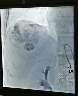 Химиоэмболизация печени отзывы