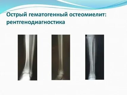 Гематогенный остеомиелит