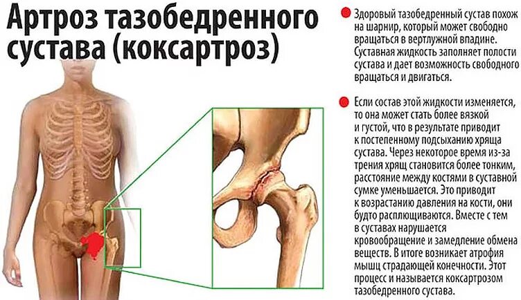 Лекарство при коксартрозе тазобедренного сустава. Коксартроз 2 степени тазобедренного. Деформирующий артроз тазобедренного сустава 4 степени. Коксартроз 2 степени тазобедренного сустава болит бедро. Коксартроз к какому врачу обратиться