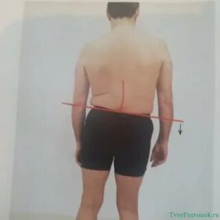 Сколиоз к какому врачу