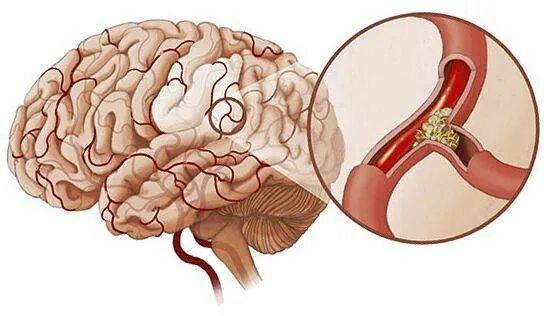 Бляшка в головном мозге. Атеросклероз сосудов головного мозга. Атеросклероз артерий головного мозга. Церебральный атеросклероз ХСМН. Атеросклероз мозговых артерий клиника.