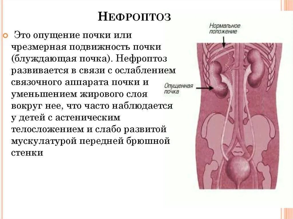 Подвижность правой почки. Анатомическое обоснование блуждающей почки. нефроптоз опущение почки. подвижная почка у женщин.