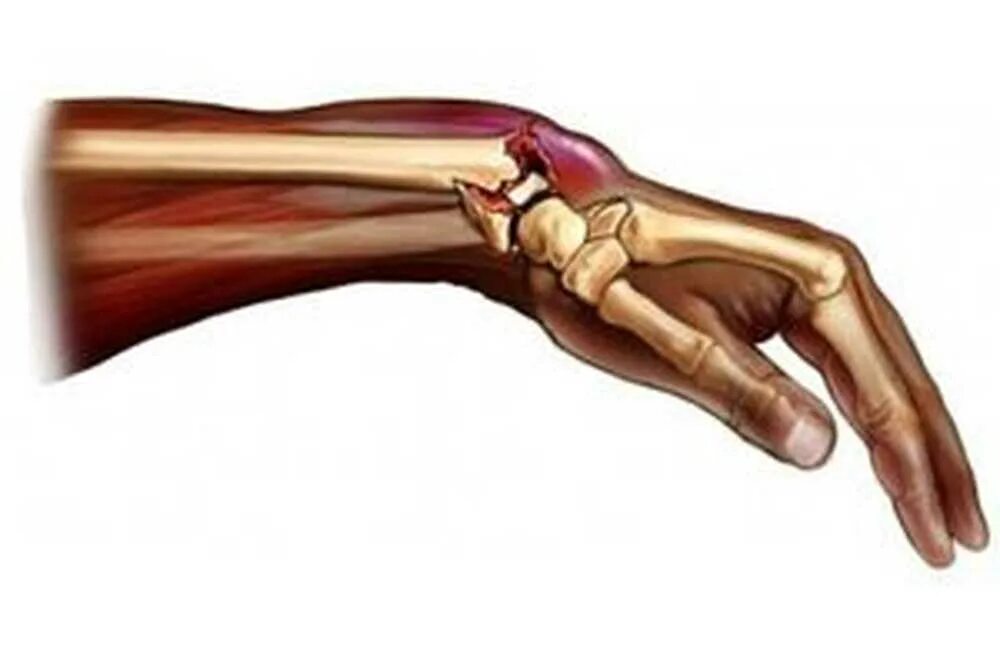 Запястно лучевой перелом руки. Перелом лучевой запястной кости. Перелом ладьевидной кости и лучевой. Перелом кистевого лучевой кости.