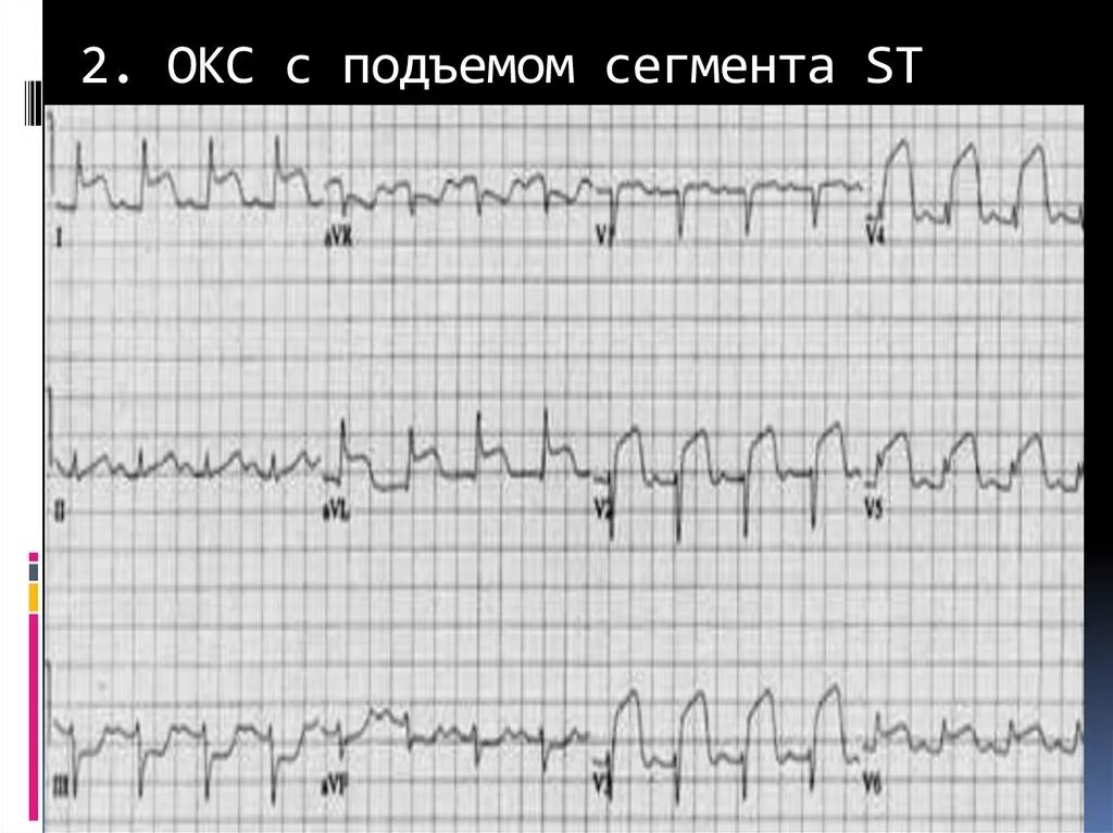 Без подъема st на экг. Острый коронарный синдром с подъемом сегмента St. Окс c подъемом сегмента ст ЭКГ. ЭКГ при Окс с подъемом сегмента St. Подъем сегмента St на ЭКГ.