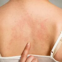Псориаз или экзема: особенности поражения кожи, тактика лечения