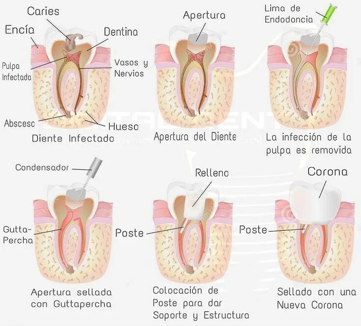 @teethfaq posted to Instagram: Accessing the nerve chamber to start a #rootcanal