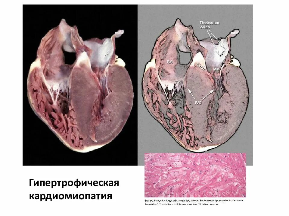 Миоэктомия. Гипертрофическая кардиопатия. Гипертрофическая миопатия. Алкогольная кардиомиопатия патологическая анатомия. Апикальная гипертрофия миокарда.