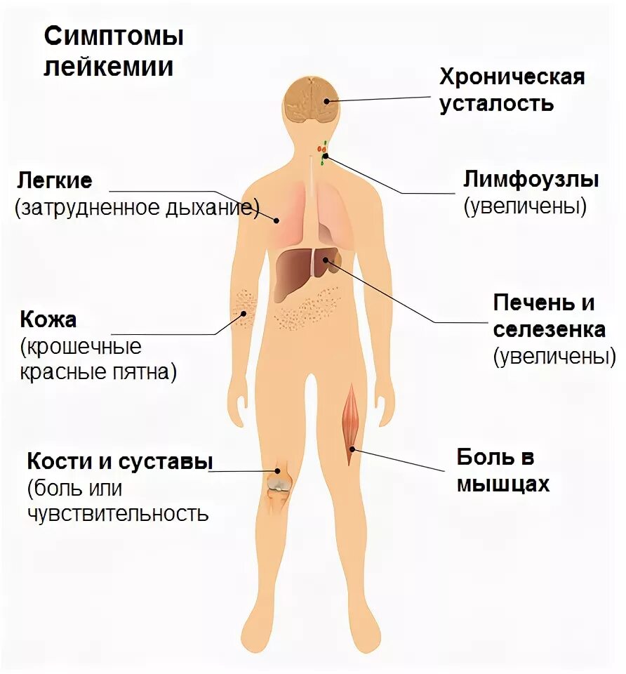 Первые симптомы лейкоза. Онкология крови симптомы. Лейкоз крови симптомы у взрослых. Симптомы злокачественных заболеваний крови.