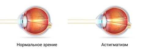 Зрение астигматизм как видит человек