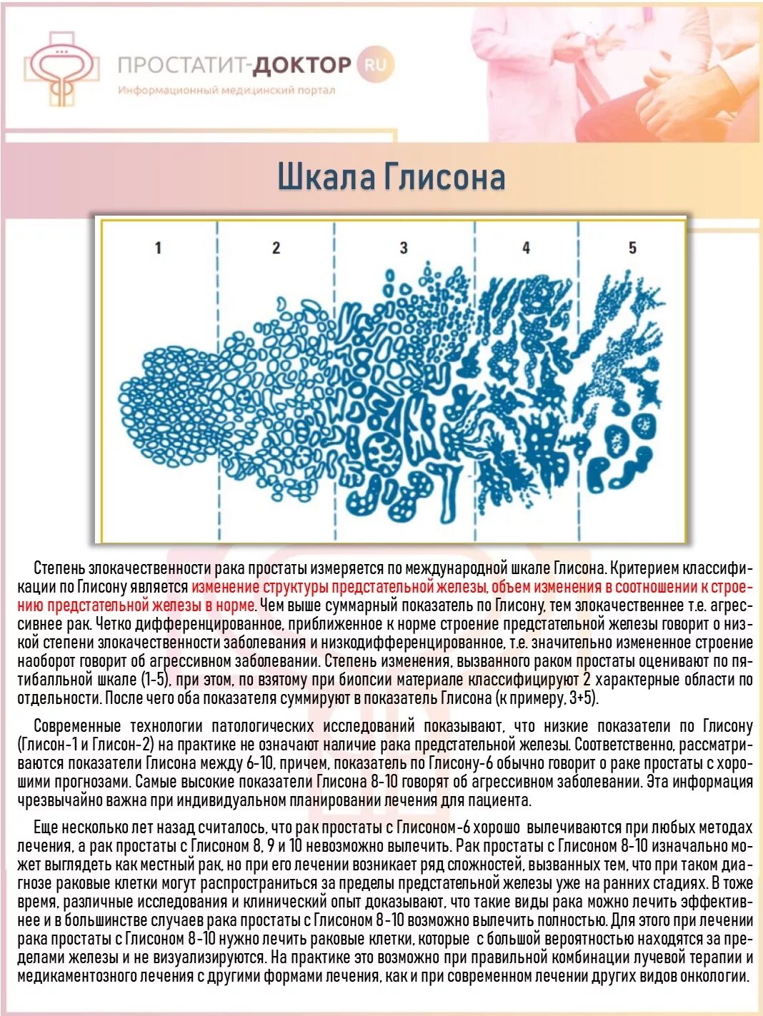 Рак простаты сколько стадий. Классификация РПЖ шкала Глисона. Шкала Глисона предстательной железы. Градации Глисона. Аденокарцинома предстательной железы Глисон.