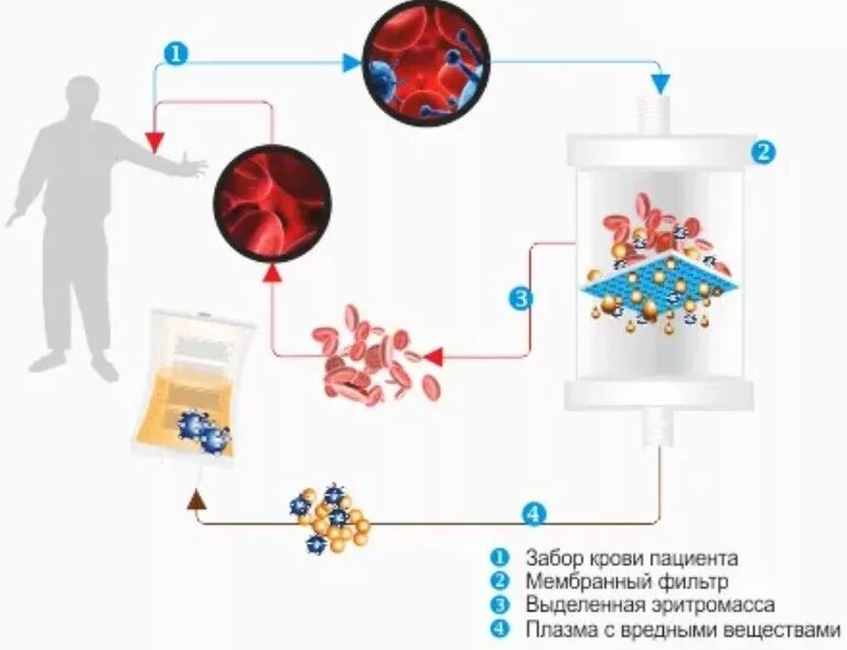 Гемофорез что это. Плазмаферез схема проведения. Мембранный плазмаферез схема. Безаппаратный мембранный плазмаферез.