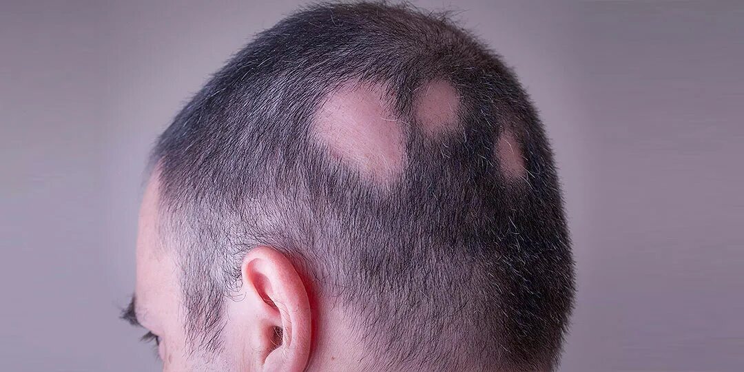 Рвет волосы на голове. Болезнь трихотилломания. Болезнь трихотилломания. Вырываю волосы на голове. Вырываю волосы на голове.