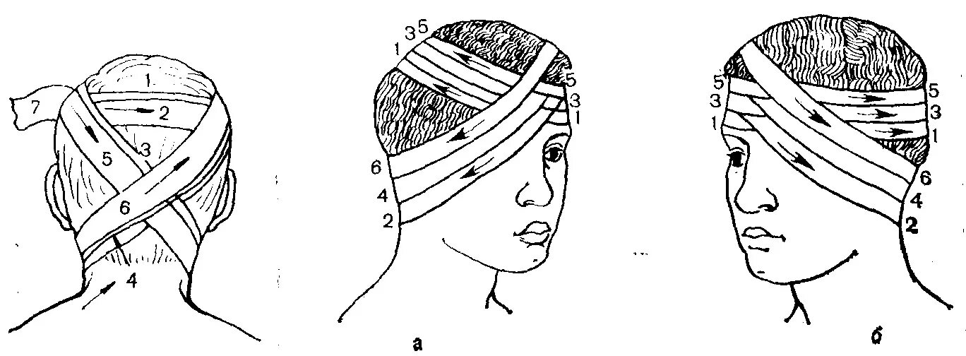 Как перевязать карту. Техника наложения монокулярной повязки. Наложение монокулярной повязки алгоритм. Техника наложении повязки на глаз монокулярная. Схема наложения монокулярной повязки.