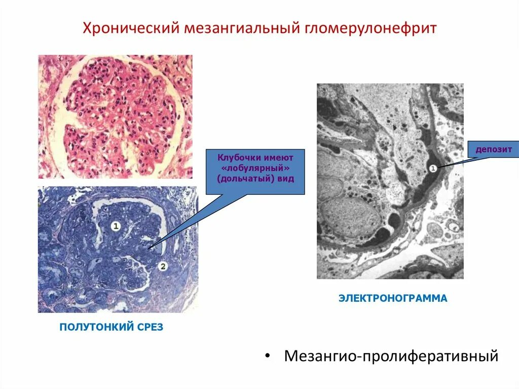 Мезангиопролиферативный гломерулонефрит. Мезангиокапиллярный гломерулонефрит гистология. Мезангиально-пролиферативный гломерулонефрит. Пролиферативный мезангиальный нефрит. Хронический диффузный гломерулонефрит