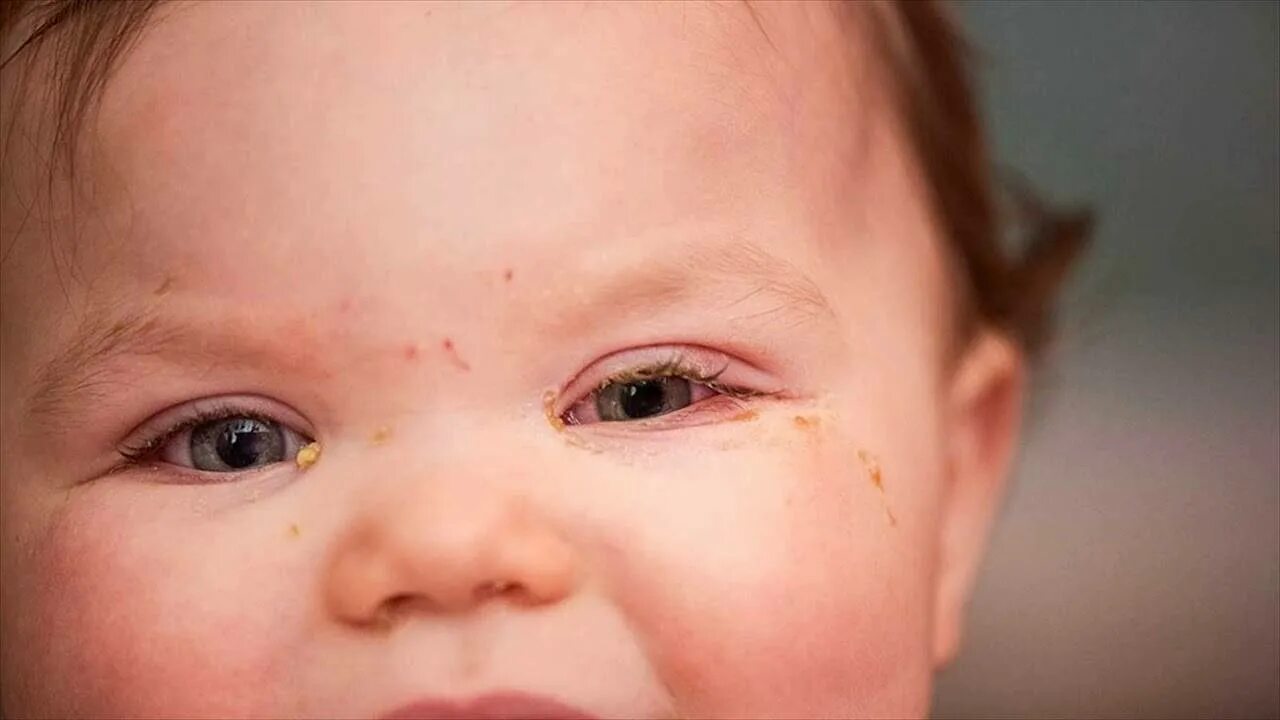 Профилактика глаз новорожденного. Гонококковый конъюнктивит новорожденных. Хламидийный конъюнктивит у новорожденных. Гонобленорейный конъюнктивит. .Гонококковый бактериальный конъюнктивит.