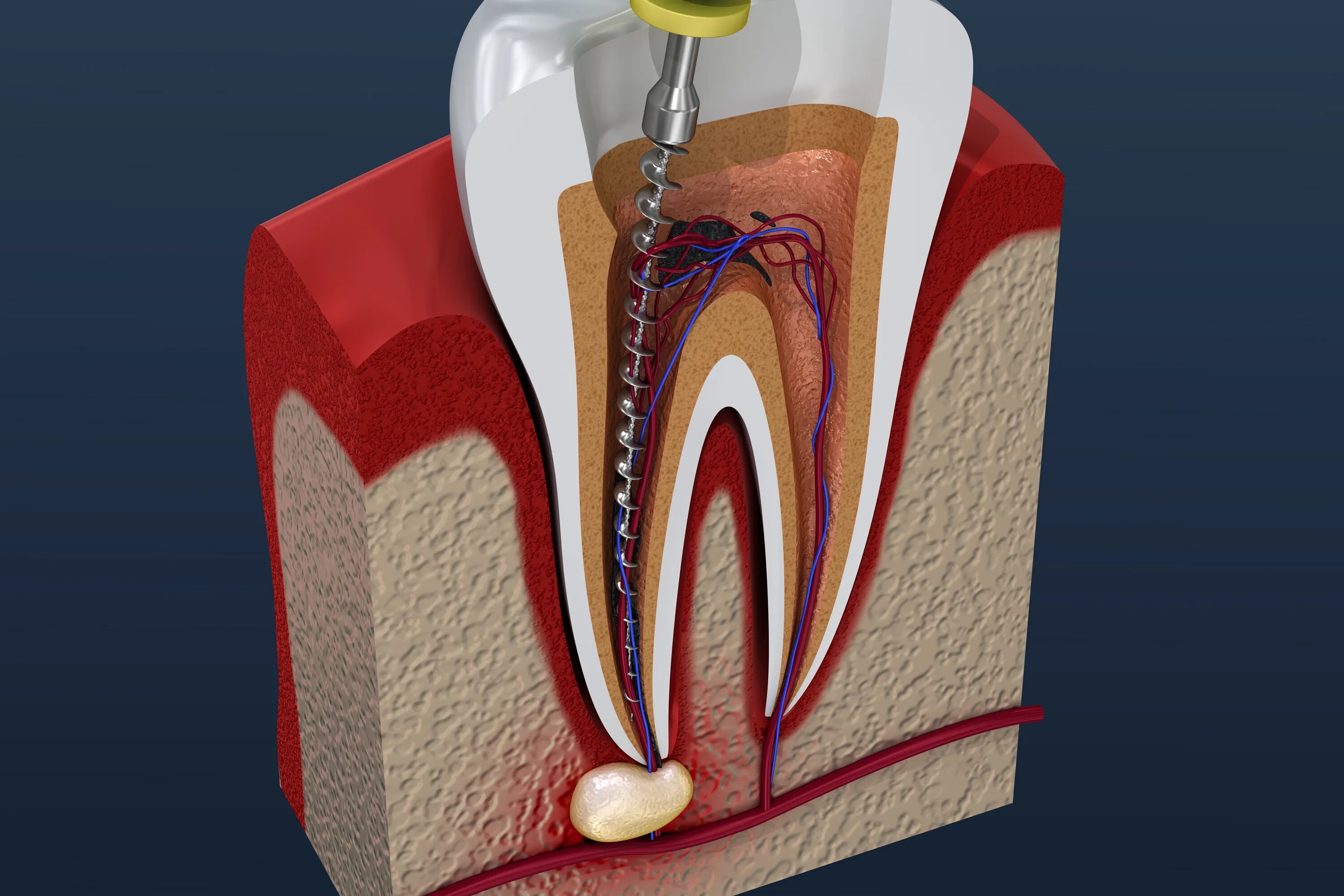 Root canal. Пульпит - воспаление пульпы зуба.