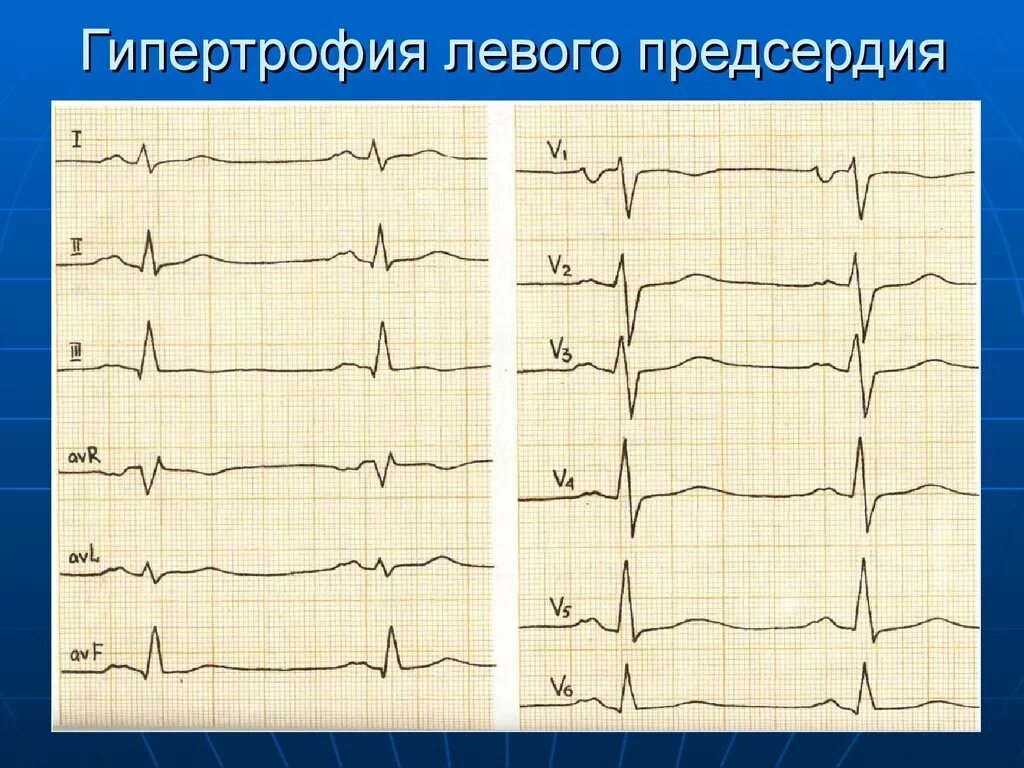 Гипертрофия предсердий. Гипертрофия правого предсердия на экг. гипертрофия левого предсердия на экг. экг гипертрофия левого предсердия пленка. признаки гипертрофии левого предсердия на экг.