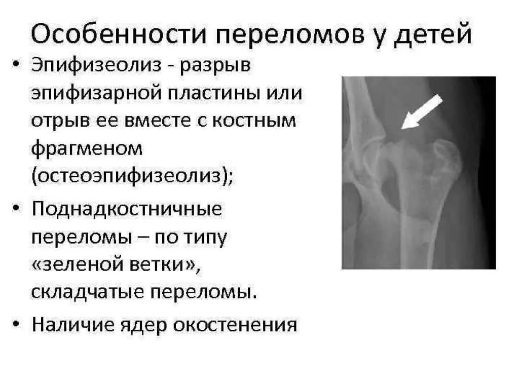 Особенности лечения переломов у детей. Особенности перелома плечевой кости у детей. Эпифизеолиз бедренной кости у детей. Особенности переломов костей у детей основные типы переломов.