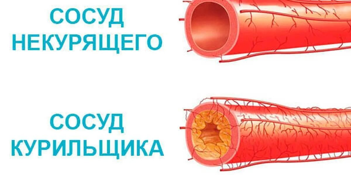 Быстрое расширение сосудов. Влияние никотина на кровеносные сосуды. Сужение кровеносных сосудов. Кровеносные сосуды курильщика.