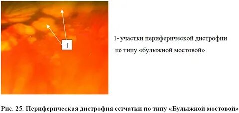 Дистрофия 1 типа