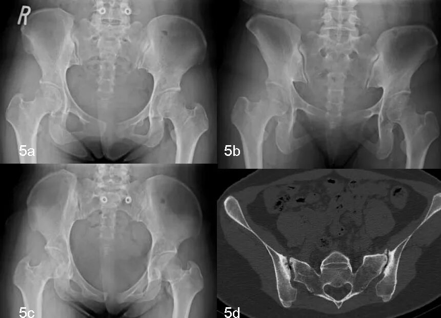 Деформирующий сакроилеит. Сакроилеит крестцово-подвздошного рентген. Кокцигодиния сакроилеит. Неспецифический сакроилеит.