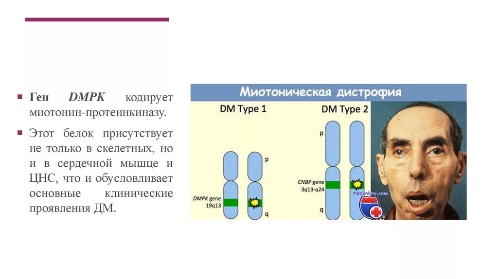 Миотония Россолимо Штейнерта Куршмана. Миотония Штейнерта Баттена. Миотония Томсена Лейдена. Россолимо-Баттена-Штейнерта-Куршманна. Миотония это