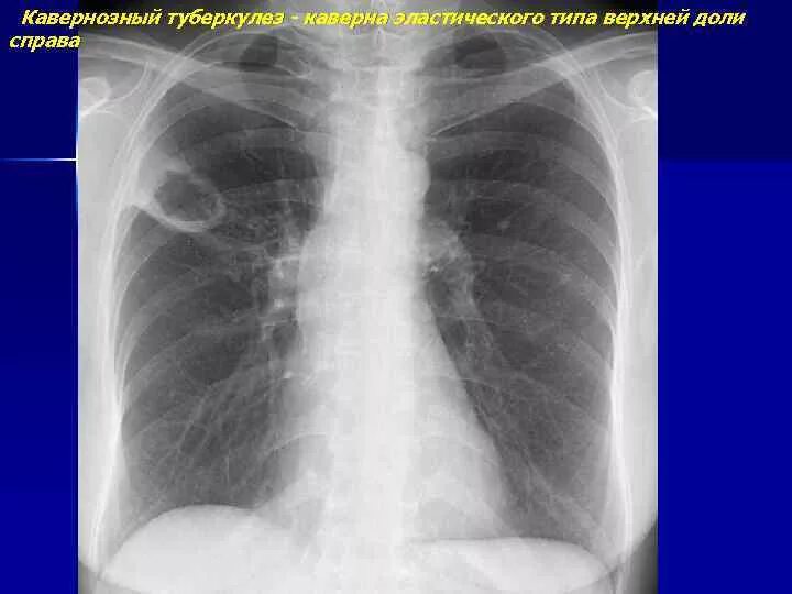 Кавернозный туберкулез рентген. Каверна туберкулез рентген. Туберкулезная каверна рентген. Кавернозный туберкулез легкого рентген.