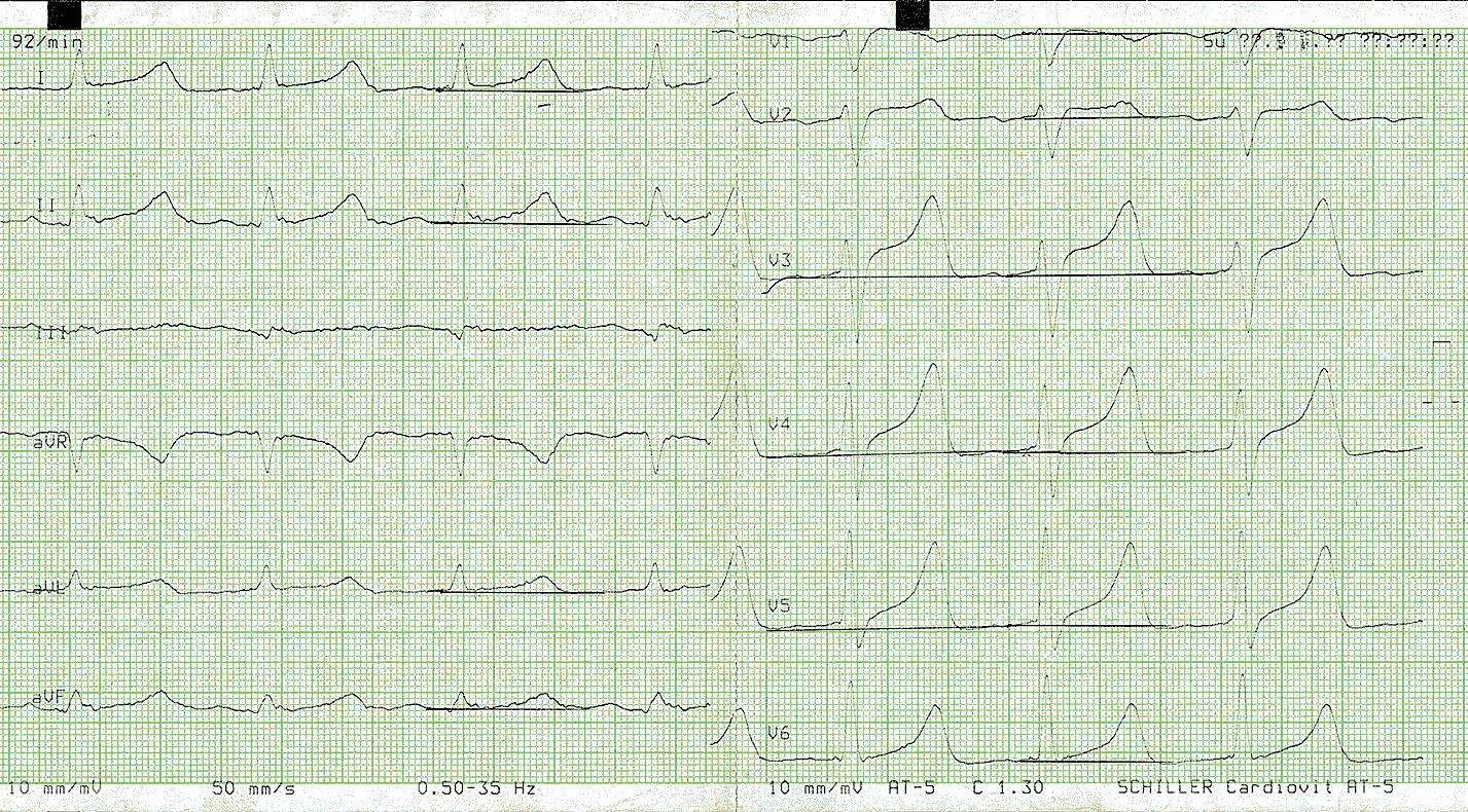 Нормальная ЭКГ 50 мм/с. Нормальное ЭКГ 25 мм. 25 Мм/с 5 мм/МВ ЭКГ. ЭКГ норма 50 мм/с. Тяжелое экг
