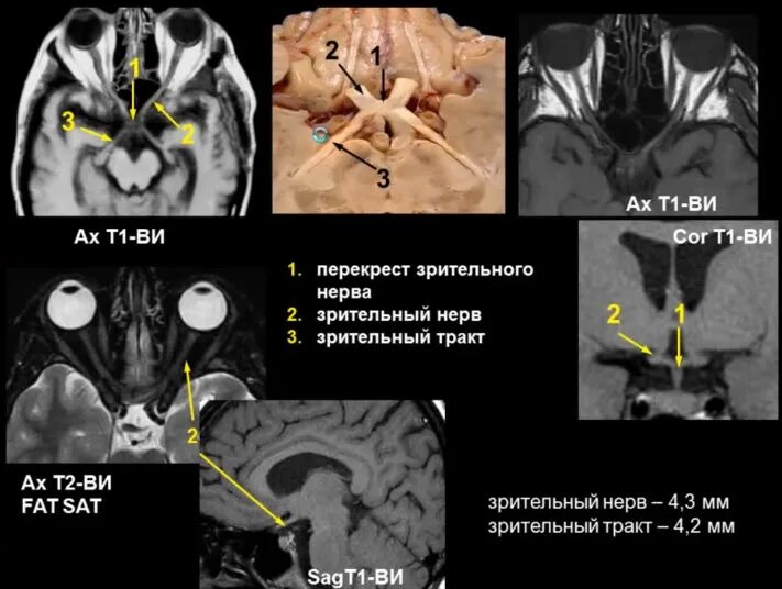 Мрт глазного нерва. Мрт хиазма зрительный нерв. Невринома зрительного нерва мрт. Хиазма мрт анатомия. Невринома зрительного нерва кт.