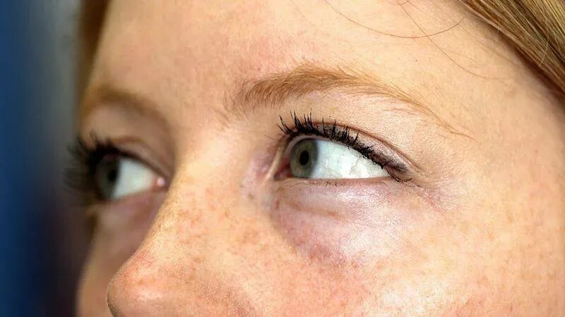 Отекаю по утрам причины. Отекаю по утрам причины. Отекаю по утрам причины. Отекаю по утрам причины. Лицо утром.