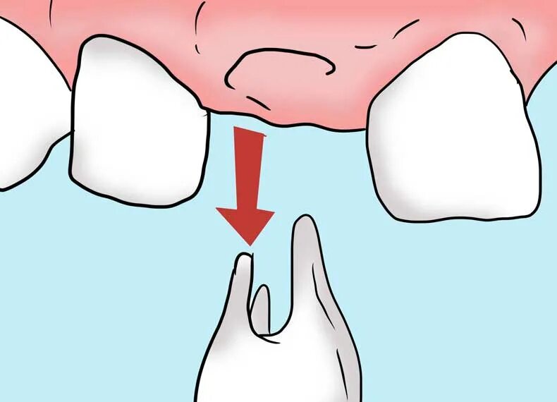 Как уменьшить боль в зубе. Зубная боль зуб мудрости.