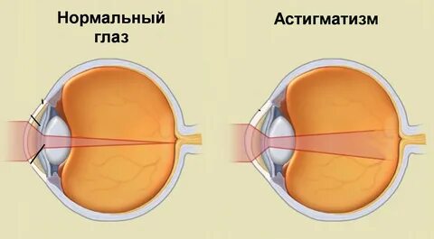 Болезнь глаз астигматизм что это