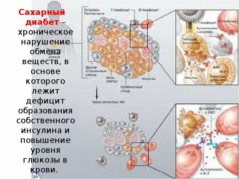Нарушение обмена веществ при сахарном диабете. Сахарный диабет нарушение обмена веществ. нарушение метаболизма глюкозы. биохимические нарушения при сахарном диабете. нарушения метаболизма при сахарном диабете биохимия.