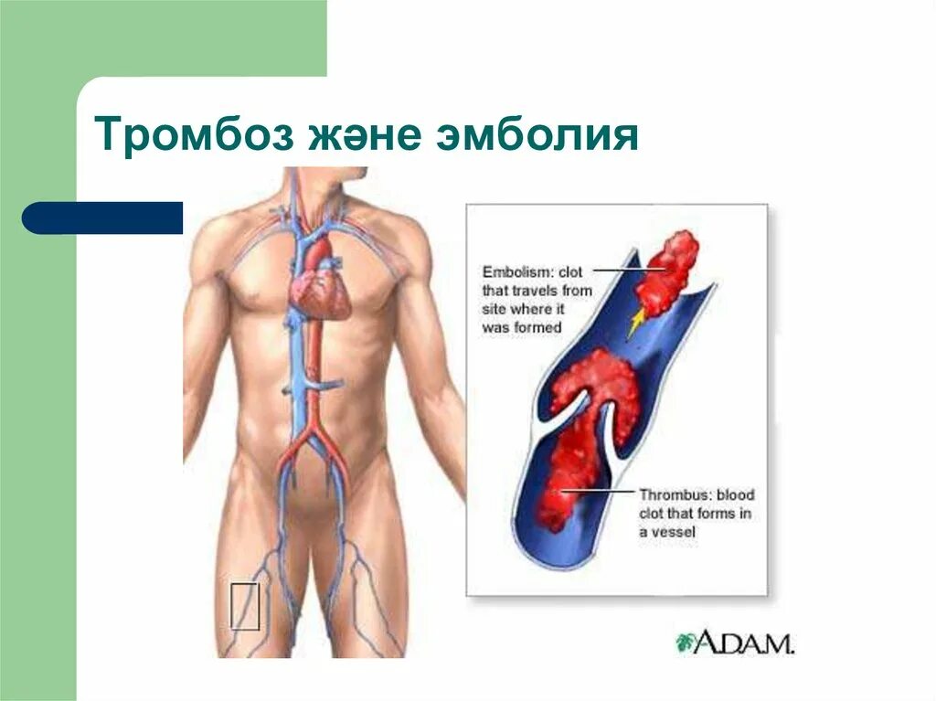 Эмболия тромбы. Тромбоэмболия и эмболия. Тромботическая эмболия.