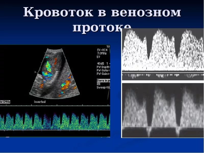 Допплеровское исследование кровотока норма. Измерение кровотока в маточных артериях. Кровоток в артериях матки. Нарушение плодово-плацентарного кровотока узи. Патологический спектр кровотока в маточной артерии.