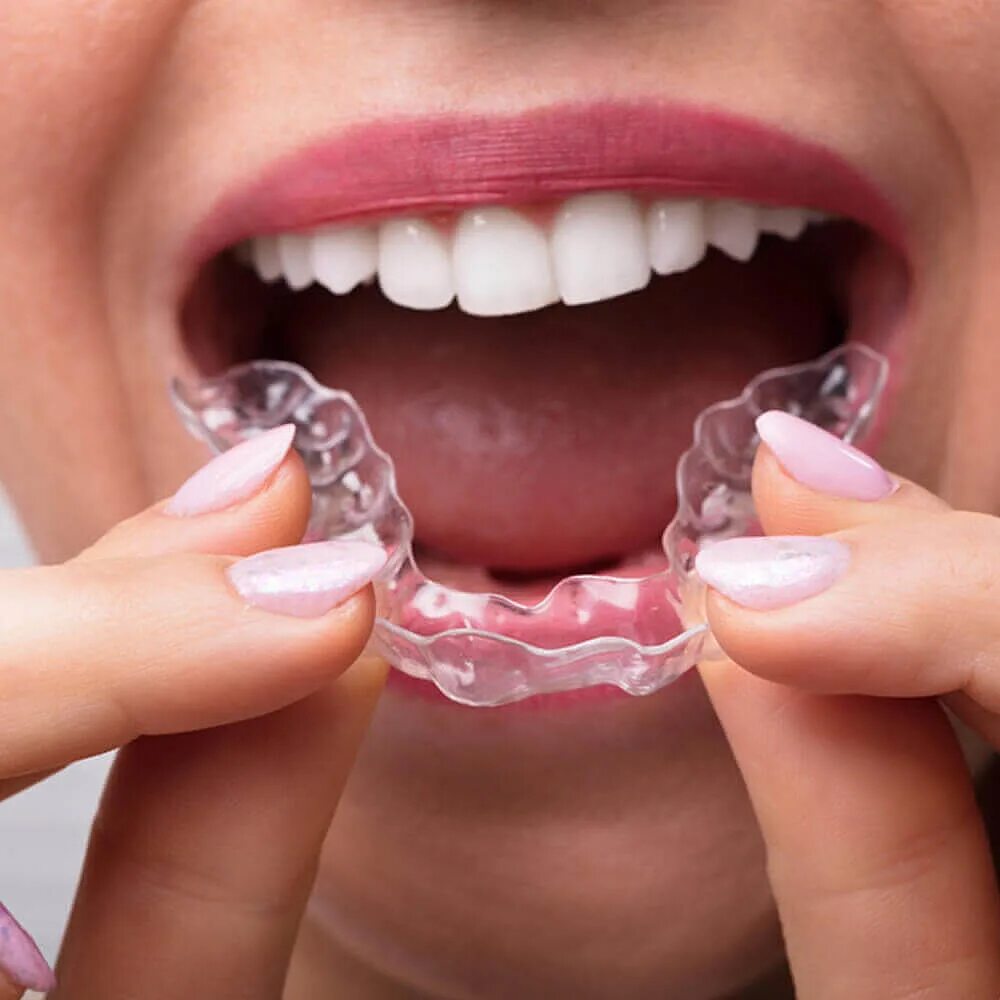 Как выглядят капы. Каппы Инвизилайн. Элайнеры Invisalign. Элайнеров Invisalign. Ортодонтические каппы элайнеры.