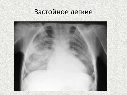 Застойная пневмония