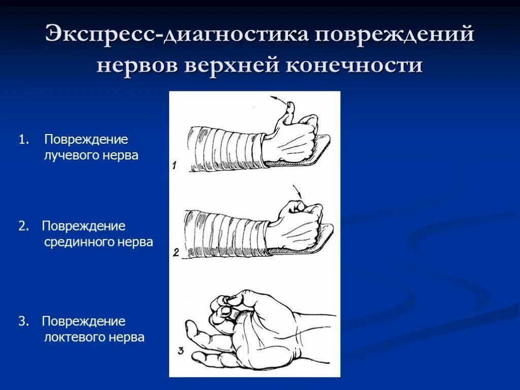 Поражение нервов руки. Положение кисти при повреждении лучевого локтевого срединного нерва. Диагностические тесты повреждения лучевого нерва. Диагностика повреждений периферических нервов конечностей. Повреждение периферических нервов верхней конечности.