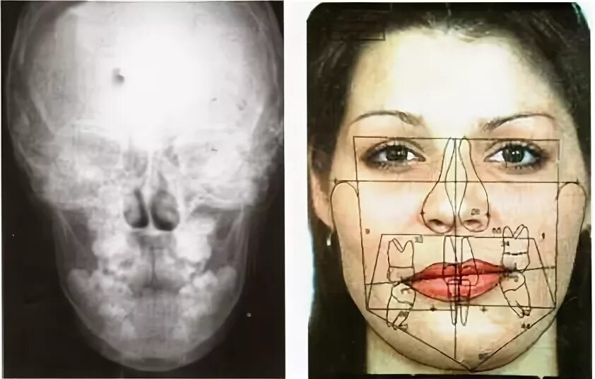 Средняя линия верхней челюсти. Средняя линия верхней челюсти. Вестибуло перекрестный прикус. Смещение средней линии зубов. Функциональные пробы ильиной маркосян.