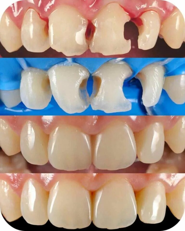 Материал для реставрации зубов. Фотокомпозитные виниры. Пришеечный кариес клыка. Межзубный пришеечный кариес. Художественная реставрация зубов.