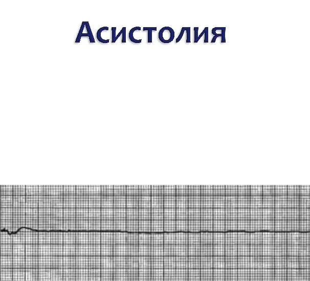 Асистолия сердца это. Асистолия желудочков на ЭКГ. Асистолия предсердий на ЭКГ. Асистолия сердца на ЭКГ. Асистолия рисунок.