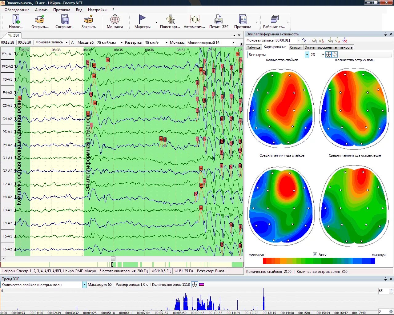 Прибор Нейрон спектр 2 энцефалограммы. Спайк волновая активность на ЭЭГ. ЭЭГ головного мозга методика проведения. Топографическое картирование электрической активности мозга.