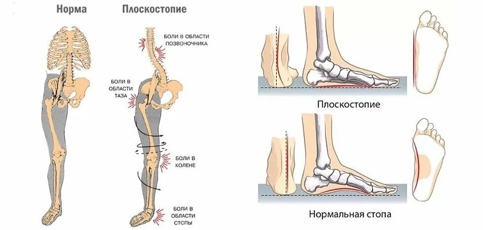 Нога имеет плоскую ползательную подошву. Продольно-поперечное плоскостопие и вальгус 3 степени. Свод стопы плоскостопие анатомия. Вальгус продольное плоскостопие. Поперечно-продольное плоскостопие симптомы.